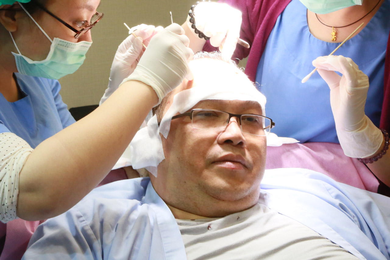 李定樊,楊名權,ARTAS,植髮機器人,植髮